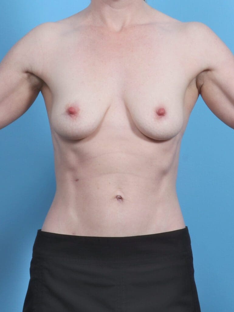 Breast Lift/Reduction with Implants - Case 50621 - Before