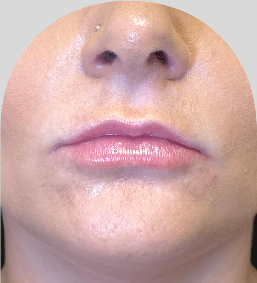 Lip Fillers - Case 50683 - Before