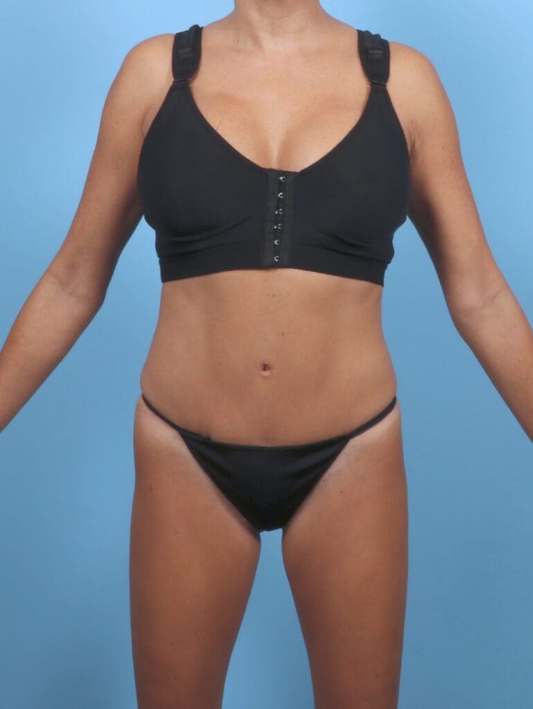 Tummy Tuck - Case 50958 - After