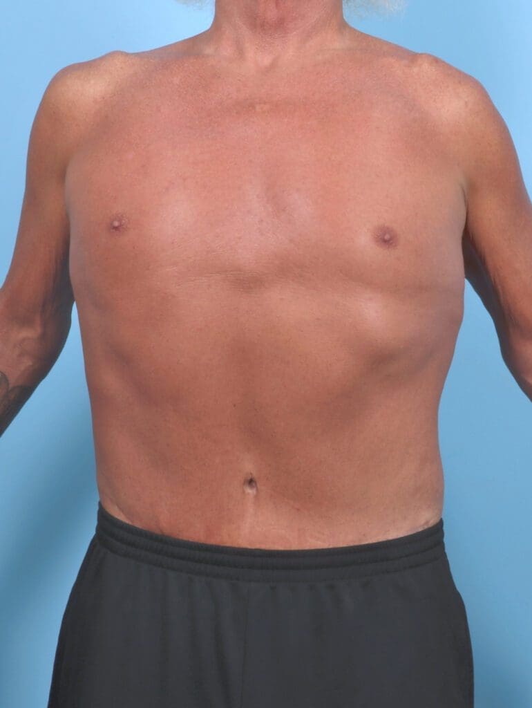 Male Body Lift Before and After Photo Gallery Folsom, CA