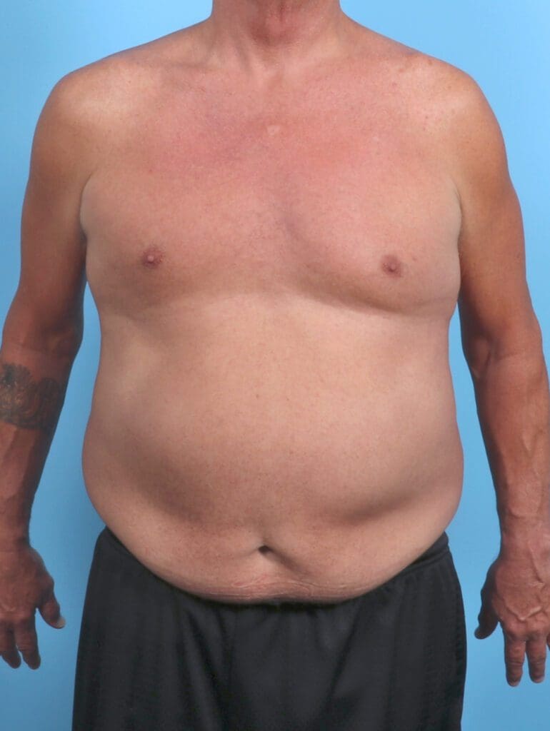 Male Body Lift - Case 51086 - Before
