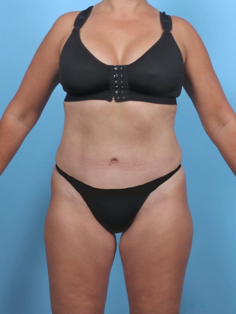 Tummy Tuck - Case 51178 - After