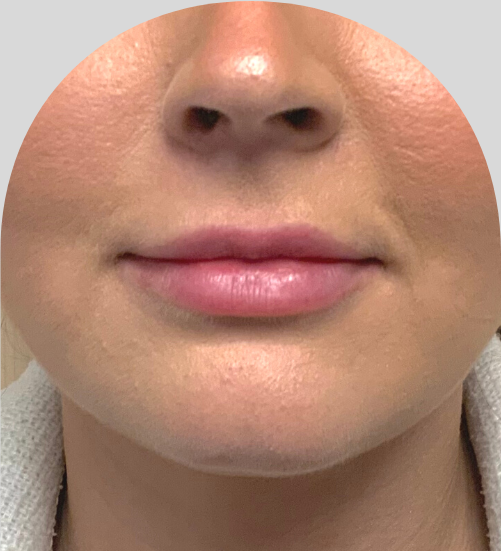 Lip Fillers - Case 51263 - Before