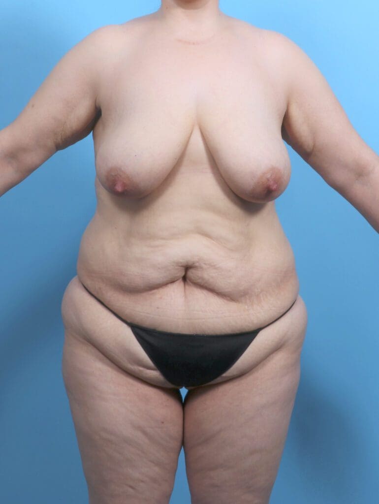 Breast Lift/Reduction with Implants - Case 51509 - Before