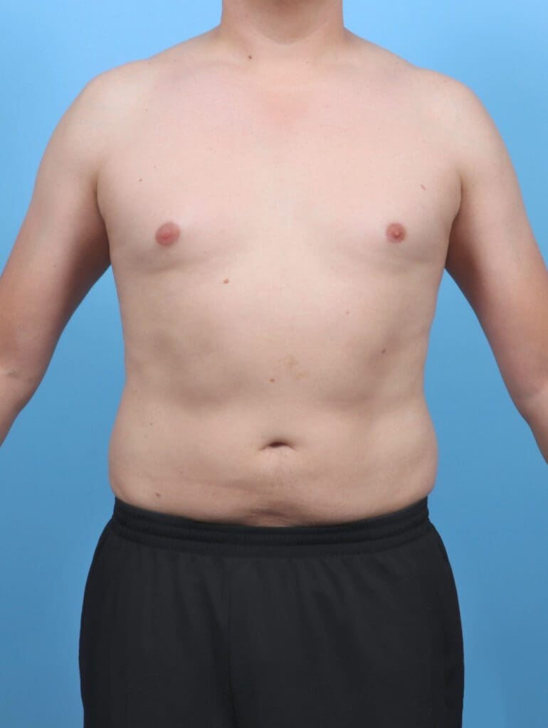 Liposuction - Case 51597 - After