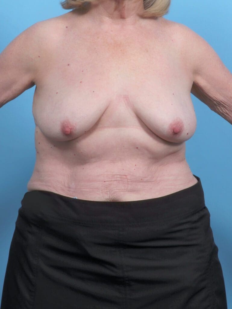 Breast Lift/Reduction w/o Implants - Case 51690 - Before