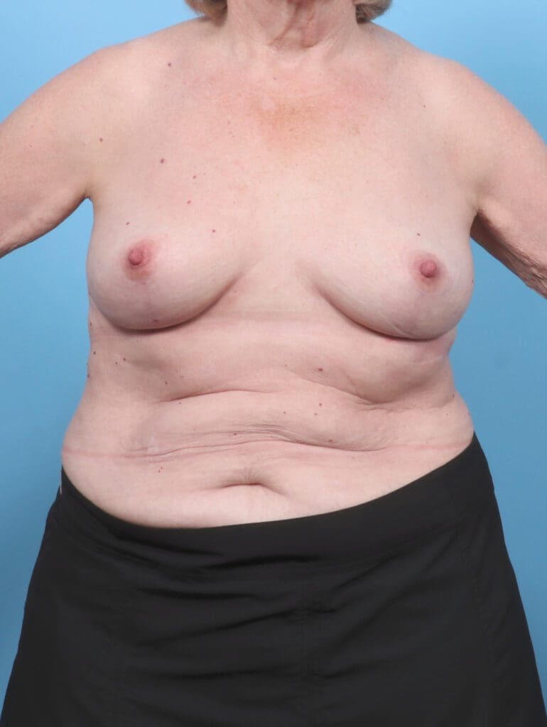 Breast Lift/Reduction w/o Implants - Case 51690 - After