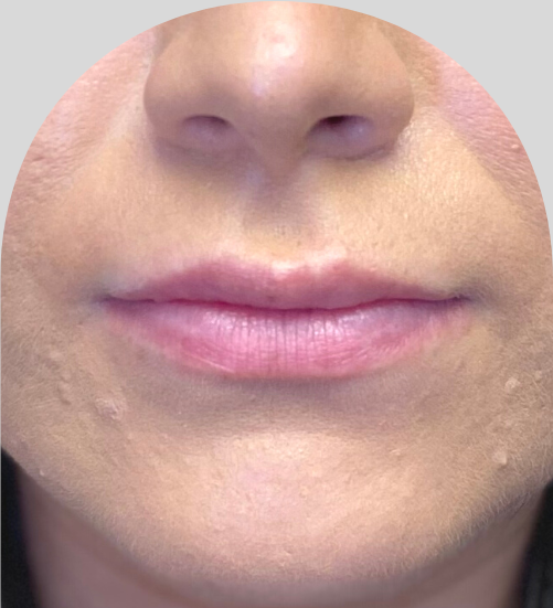 Lip Fillers - Case 51901 - Before