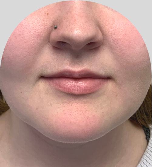 Lip Fillers - Case 51905 - Before