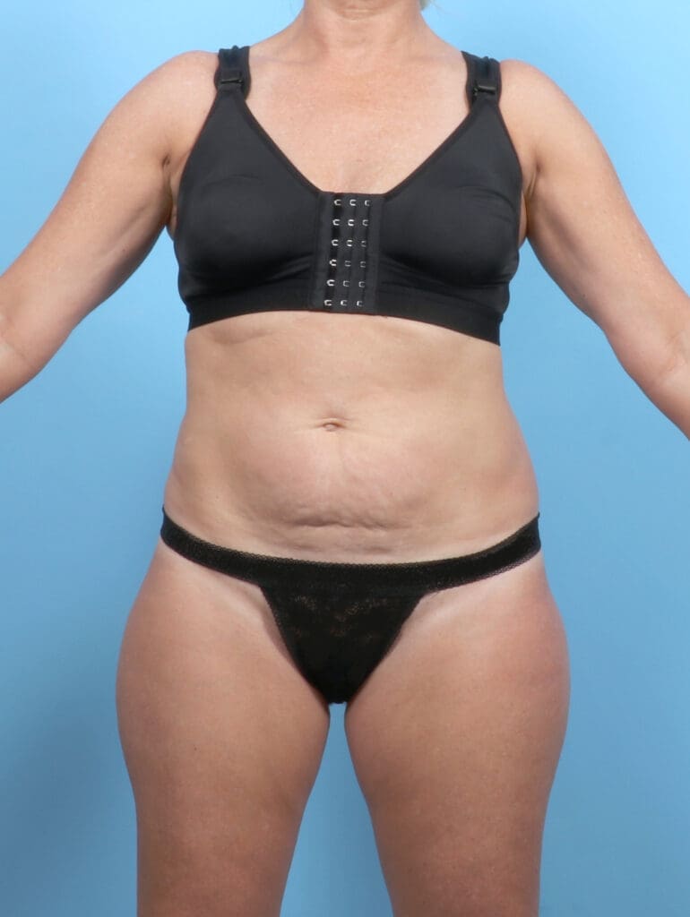 Tummy Tuck - Case 53291 - Before