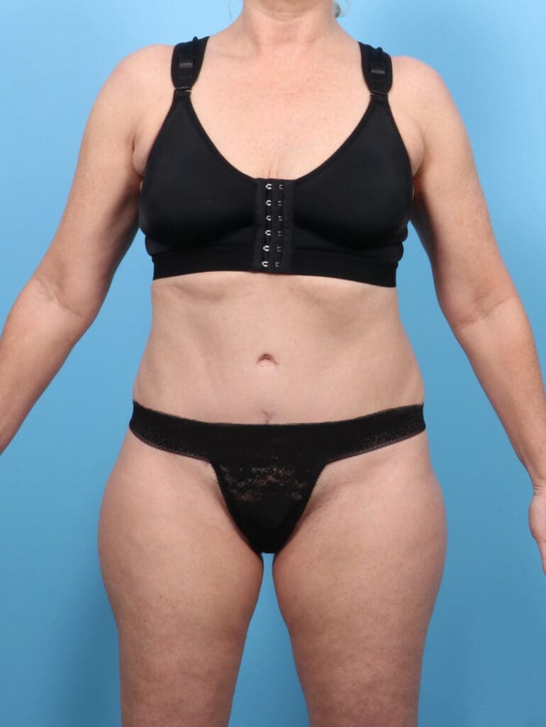 Tummy Tuck - Case 53291 - After