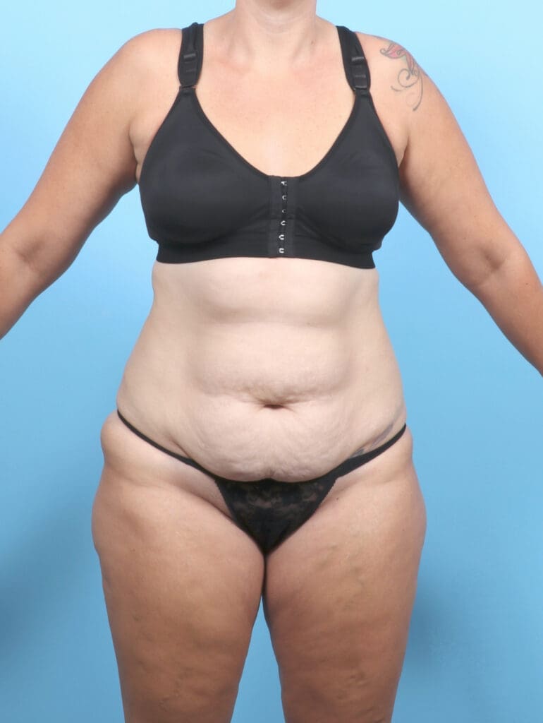 Tummy Tuck - Case 53299 - Before