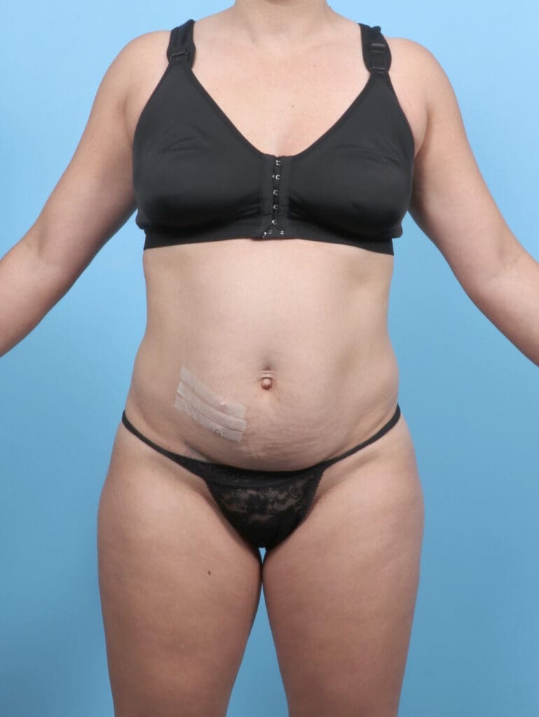 Tummy Tuck - Case 53385 - Before