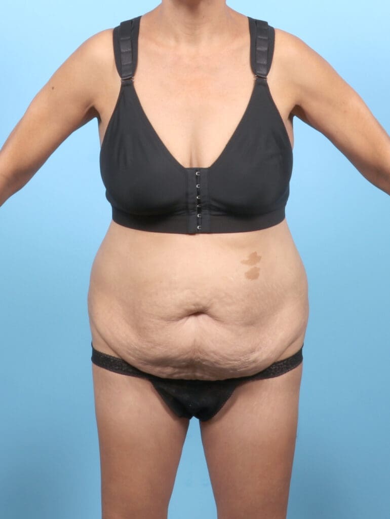 Tummy Tuck - Case 53553 - Before