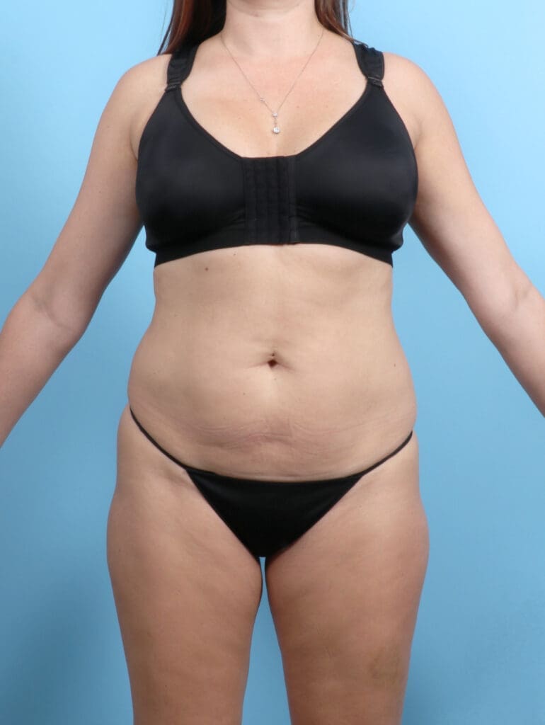 Tummy Tuck - Case 53611 - Before