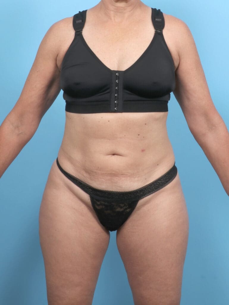 Tummy Tuck - Case 54022 - Before