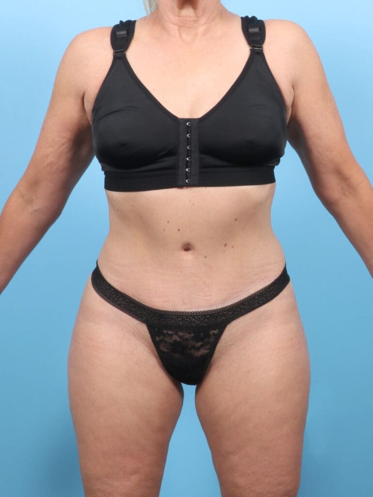 Tummy Tuck - Case 54022 - After